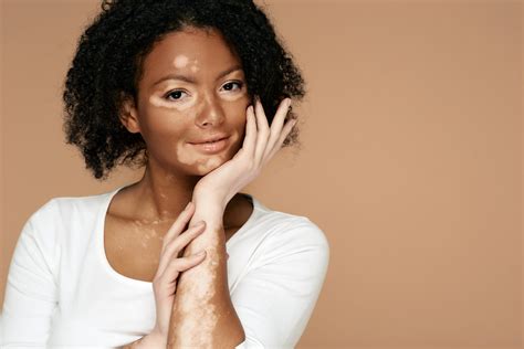 vitiligo fotos|Vitiligo Images